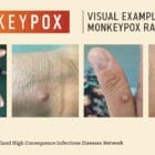 [CREDIT: CDC] Monkeypox is spreading across the U.S. with four known cases in Rhode Island. The virus causes a rash that can occur on the hands and feet, and genitals. It is spread mainly through close, intimate contact.
